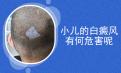 白癜风北京专科医院专家介绍：白癜风患者长期熬夜的危害