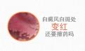 北京专家分析白癜风的白斑用药之后发红是怎么回事