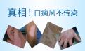 北京治疗医院：白斑病到底传不传染