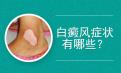 北京白癜风医院专家介绍白癜风的症状表现有哪些方面？